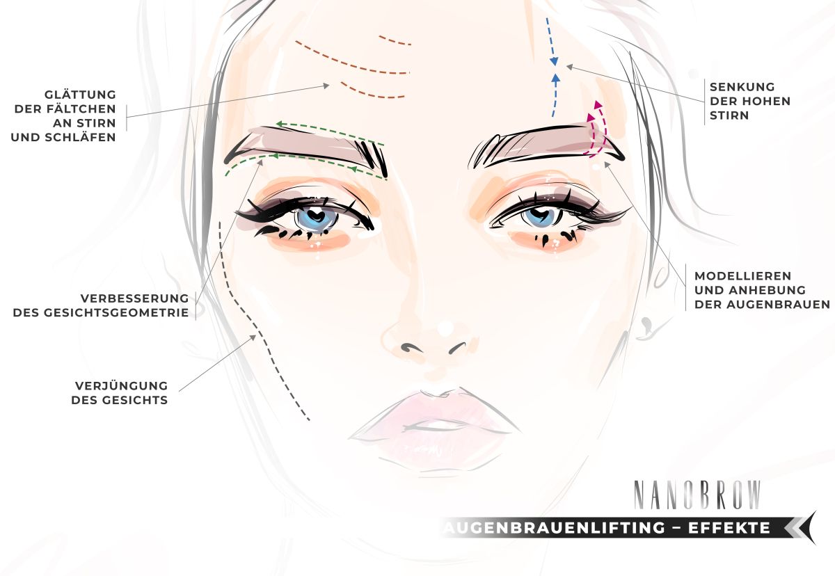 Augenbrauenlifting – Effekte: Verjüngung des Gesichts; Senkung der hohen Stirn; Glättung der Fältchen an Stirn und Schläfen; Modellieren und Anhebung der Augenbrauen; Verbesserung des Gesichtsgeometrie